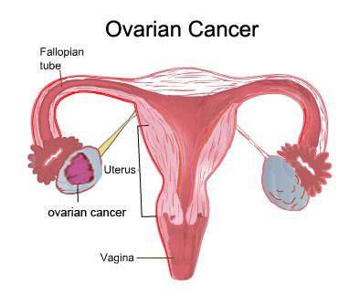 symptoms of ovarian cancer