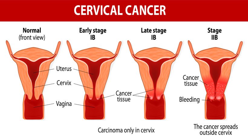 Precancerous conditions of the cervix